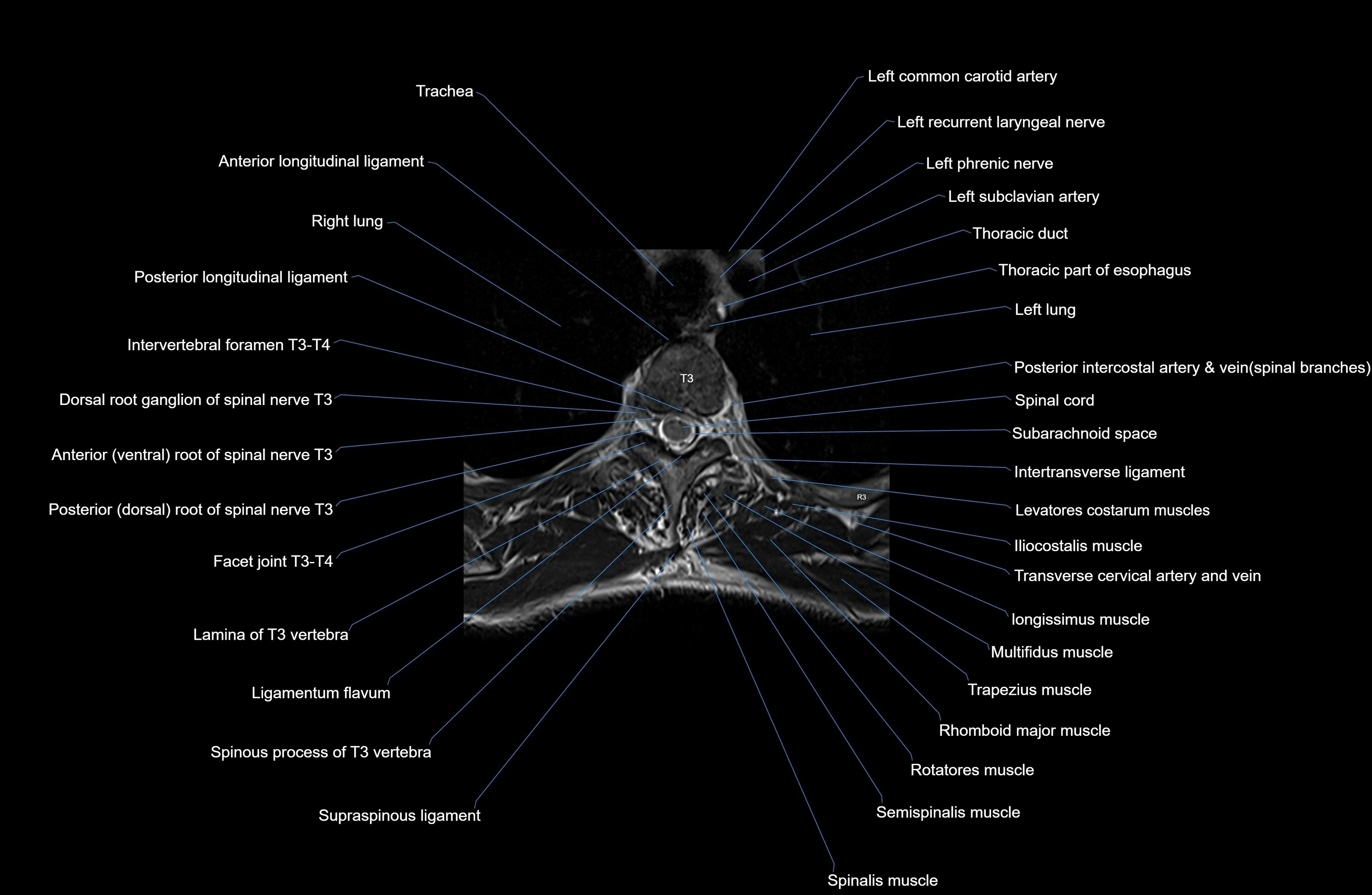 MRI thoracic spine axial  cross sectional anatomy 3T radiology  image-img-00001-00021.webp